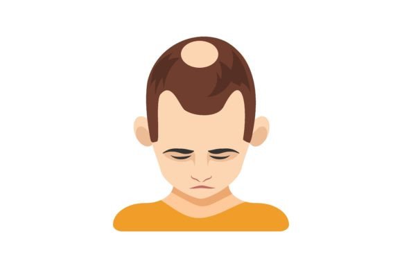 Download Second Stage of Alopecia in Men Vector I - Vector Collection