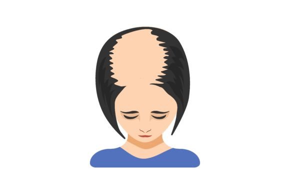 Download Four Stage of Alopecia in Women Vector I - Vector Collection