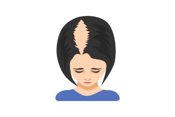 Download Second Stage of Alopecia in Women Vector - Vector Collection